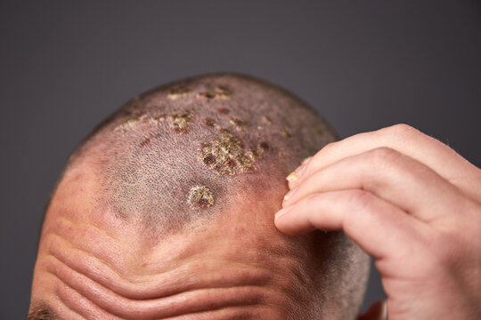 Man with dry flaky skin on his head with psoriasis and nail fungus on hands. Autoimmune genetic disease.