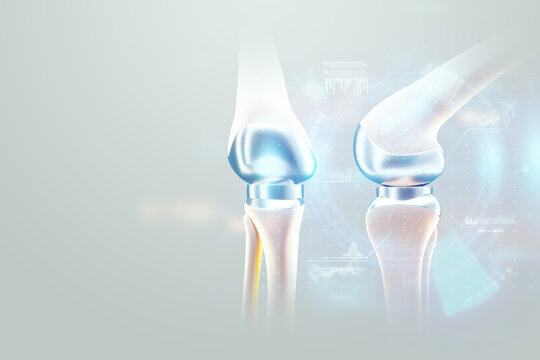 hip implant Medical poster, image of the bones of the knee, artificial joint in the knee. Arthritis, inflammation, fracture, cartilage,. Copy space, 3D illustration, 3D render.