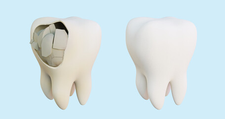 3d illustration render of tooth enamel destruction spot, caries, dentin lesion, hole, treatment, filling, molar treatment, restoration, healthy tooth