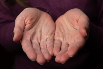 A woman is showing her dry and cracked skin caused by frequent disinfection. 