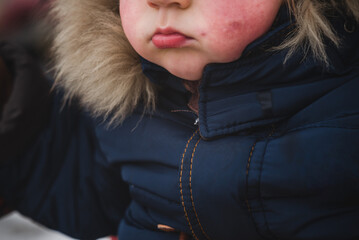 two years old boy child with red cheeks- enterovirus infection, diathesis or allergy symptoms....