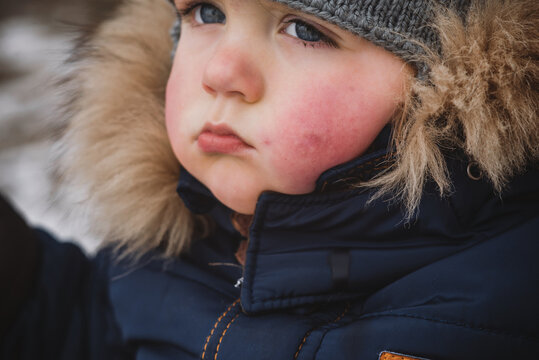 two years old boy child with red cheeks- enterovirus infection, diathesis or allergy symptoms. Redness and peeling of the skin on the face. Cold allergy urticaria