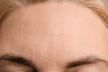 Female forehead without  wrinkles
