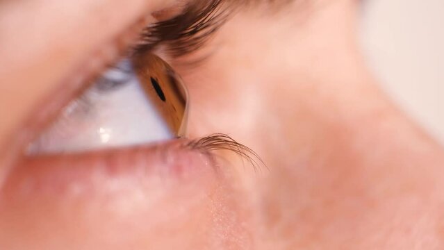 Eye of a patient with keratoconus, cornea in the form of a cone, severe degree of the disease.