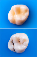 tooth restoratin by esthetic composite filling befor e and after picture