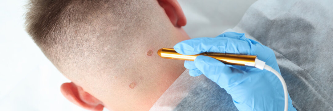 Traces on male neck after laser removal closeup