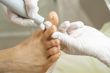 Hardware medical pedicure with nail file drill apparatus. Patient on pedicure treatment with pediatrician chiropodist. Foot peeling treatment at spa with a special device. Clinic of Podiatry Podology.