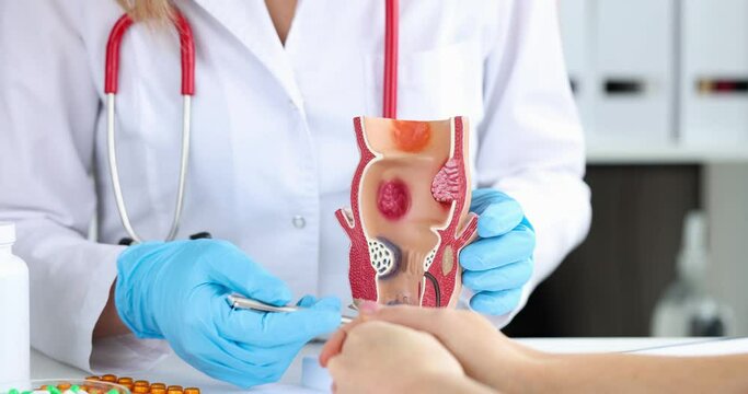 Doctor shows formation of hemorrhoids on model of rectum closeup
