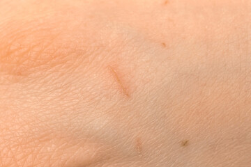 Fototapeta premium Human skin texture with scratches. Detail healthy pink skin background photo