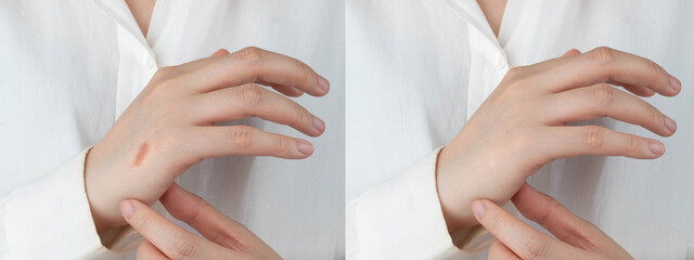 Close up of woman hands before and after treatment cream to removal burn scar. Dermatology and skin...