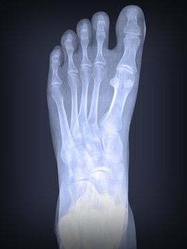 x-ray of a left foot with osteoporosis damage