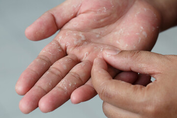 Dry hands peeling skin on hand and fingers. air allergy, chemical allergy.Dermatitis. Eczema