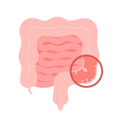 Colonoscopy intestine, polypectomy procedure, removal polyp in colon. Checkup gut, colon surgery. Operation intestine. Vector illustration - obrazy, fototapety, plakaty