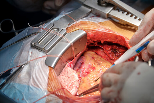 Closeup of professional doctor hands operating a patient during open heart surgery in surgical room. Healthcare and medical intervention concept