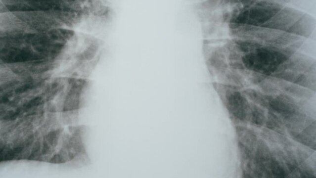 Lungs x-ray close-up. Doctor looking at ribs roentgen, human chest. Healthcare and medicine concept, checkup.