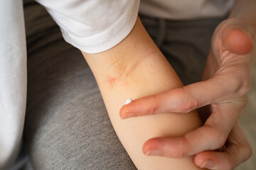 mom applies the ointment to dermatitis on the bend of the elbow in a little girl. inflammatory skin...