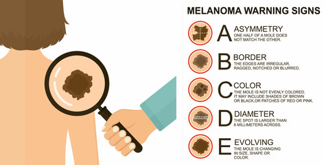 Diagnosis of skin cancer. Melanoma warning signs. Dermatological screening. UVB prevention of squamous cell treatment. Basal test. ABCDEs of skin cancer screening.  - obrazy, fototapety, plakaty