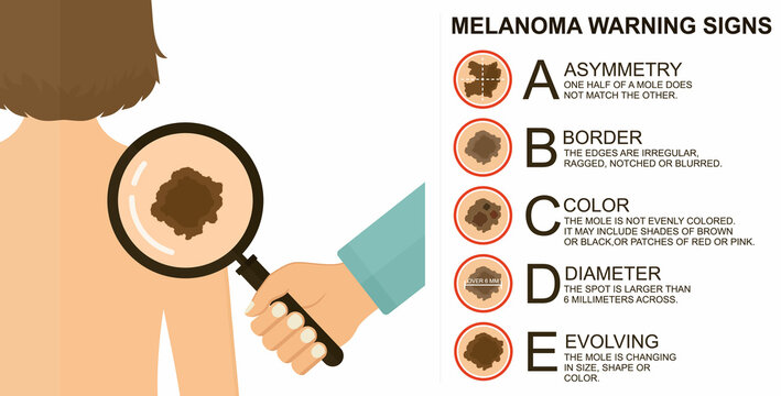 Diagnosis of skin cancer. Melanoma warning signs. Dermatological screening. UVB prevention of squamous cell treatment. Basal test. ABCDEs of skin cancer screening. 