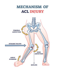 Mechanism of ACL injury as knee trauma anatomical explanation outline diagram. Labeled educational anterior cruciate ligament twist, abduction, ankle eversion and femoral adduction vector illustration - obrazy, fototapety, plakaty