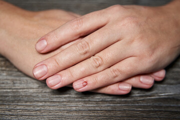 Koenen's tumor. growth over the nail on the female hand - obrazy, fototapety, plakaty