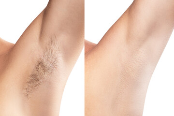Comparison of female armpit after hair removal - obrazy, fototapety, plakaty