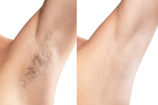 Comparison of female armpit after hair removal