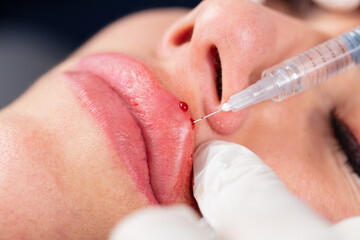 Young lady getting botox injection for bigger, fuller lips. The woman in the beauty salon. Plastic surgery clinic.