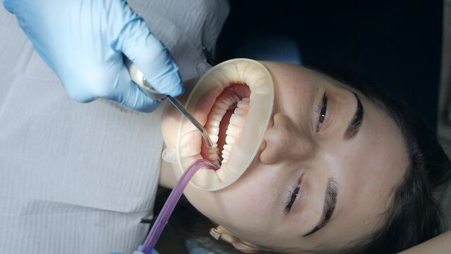 Young woman with a retractor in her mouth in a dental clinic. Brushing teeth with water. Dentist using saliva ejector or dental pump