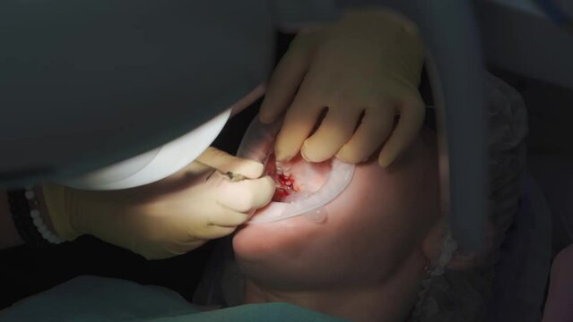 real. dentist pulls out a sick wisdom tooth. 