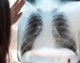 X-ray of the lungs in the hands of a pneumologist. A lung shot shows a shadow on the lungs - 484521701