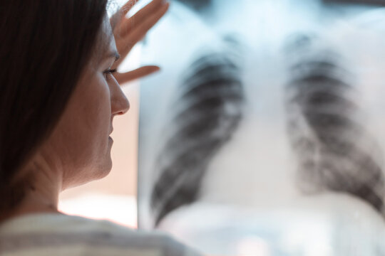 X-ray of the lungs in the hands of a pneumologist. A lung shot shows a shadow on the lungs