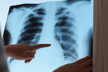 Woman doctor hands holding patient chest x-ray film before treatment - 484522152