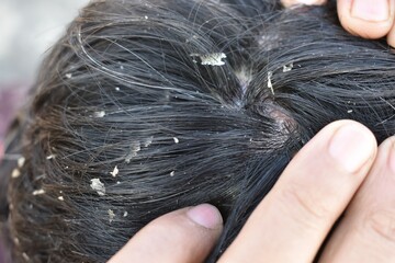 Men's hair is a top view close-up with Gray hair and Dandruff