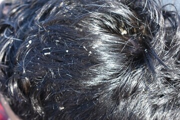 Men's hair is a top view close-up with Gray hair and Dandruff