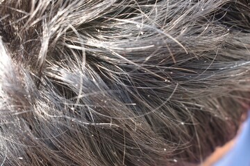 Men's hair is a top view close-up with Gray hair and Dandruff