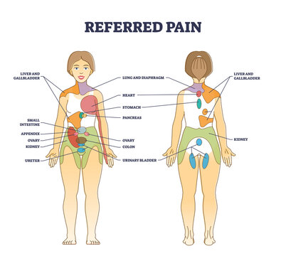 Referred pain location as body painful stimulus organ origin outline diagram. Labeled educational chart with problem zones projection vector illustration. Internal medical disease diagnostics map.