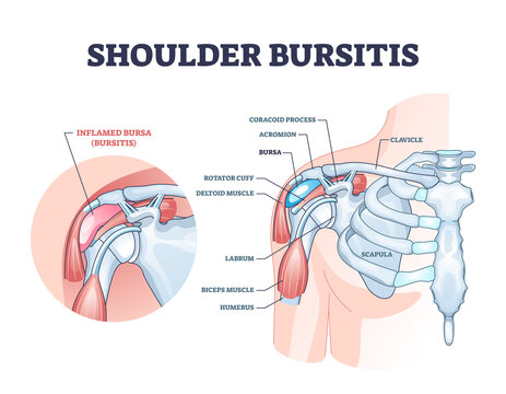 Shoulder bursitis as medical painful bursa inflammation outline diagram. Labeled educational disease explanation with anatomical structure and inner body medical injury description vector illustration