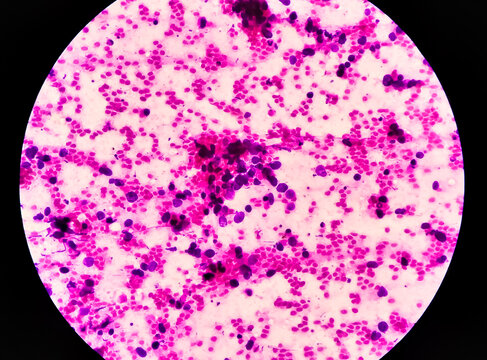 Right lung mass MRI  Guaided FNA microscopic show positive for malignant cell, small cell carcinoma. cytology