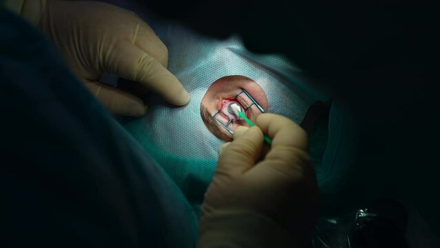Surgery eye laser correction. Eyesight clinic operating cataract surgery proccess.