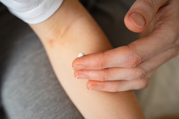 mom applies the ointment to dermatitis on the bend of the elbow in a little girl. inflammatory skin lesions in children. creams and ointments for the treatment of skin irritations. selective focus