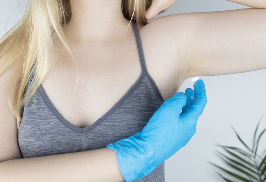 Girl in a blue medical glove smears a cream with botulinum toxin under her armpit. Novelty in cosmetology and medicine. Replacement of injection therapy. Painless treatment for excessive sweating.