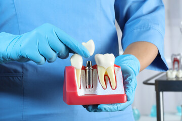 Dentist putting crown onto abutment of dental implant between teeth in clinic, closeup - obrazy, fototapety, plakaty