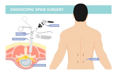 Endoscopic spine surgery micro facet syndrome Bone spurs joint Leg incisions tubular retractor canal vertebrae Fractured foraminotomy microforaminotomy microlaminectomy microlaminotomy Disorder - obrazy, fototapety, plakaty