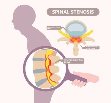 Spinal stenosis a narrowing of the spaces of the spine that causes lower back pain annulus nucleus bulged older cord muscle weakness neck cauda equina injury cushioning vertebrae disk bone