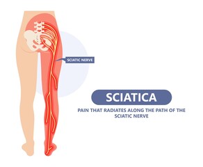 Sciatica nerve pain lower back through hips to leg	