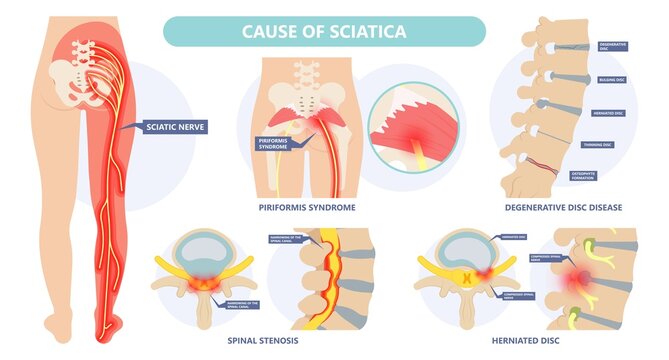 Sciatica nerve pain lower back through hips to leg	