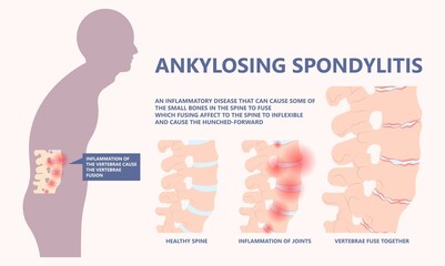Ankylosing Spondylitis osteoporosis Skeletal pelvis Stiffness chronic knee ankle spondylolysis