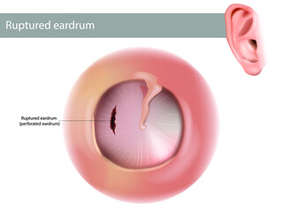 Ruptured eardrum or perforated eardrum. Tympanic membrane perforation. Hole in the eardrum.  - obrazy, fototapety, plakaty
