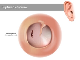 Ruptured eardrum or perforated eardrum. Tympanic membrane perforation. - obrazy, fototapety, plakaty