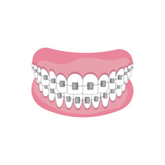 Teeth with braces on white background. Alignment of bite of teeth, correct bite of teeth. Dental jaw with braces, Dental braces. Vector illustration